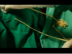 Ngeri, dokter di India coba keluarkan cacing pita sepanjang 2 meter dari perut